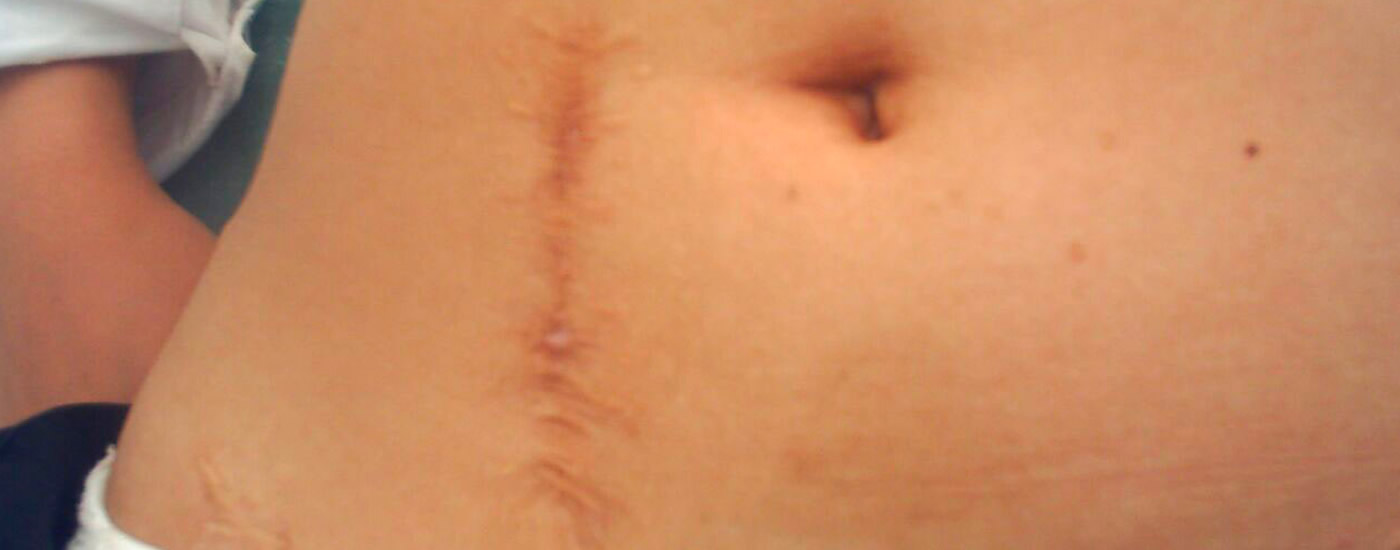 Cicatrices Hipertróficas Y Queloideas